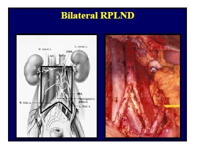 Retroperitoneal lymph node dissection Το 18-30% των ασθενών έχουν βρεθεί με οπισθοπεριτοναϊκή λεμφαδενική μετάσταση σε RPLND (παθολογικό