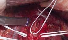 Retroperitoneal lymph node dissection Οξεία Νοσηρότητα Διαπύηση τραύματος