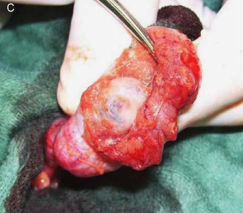 Χειρουργική διατήρησης οργάνου (C) The adjacent testicular parenchyma is