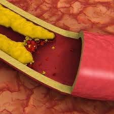 CVD and ED ED not only shares risk factors with CVD but also constitutes itself an independent marker of increased risk for CVD.
