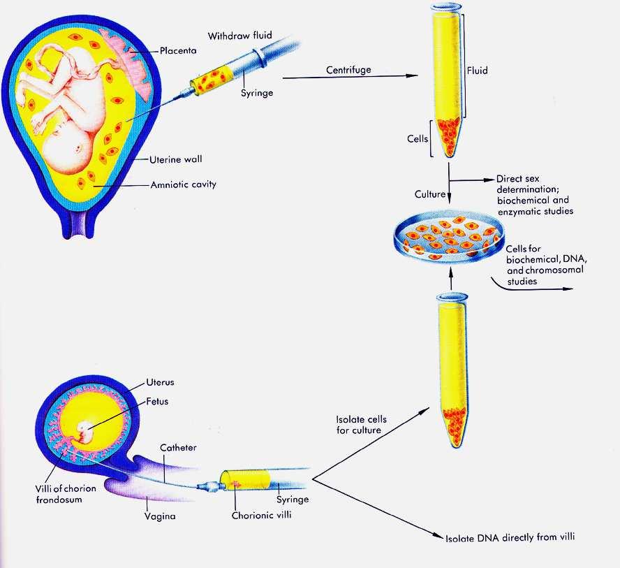 Amniocentesis& trophoblast(cvs) sampling Amniotic Fluid 15 ml amniotic fluid yields 5 mg ofdna (Maybecultured)