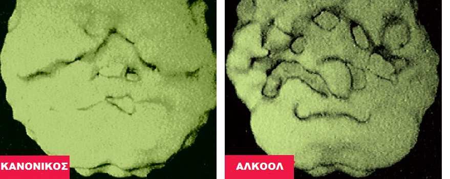 εγκέφαλο SPECT CTscan2 νέων 18 ετών