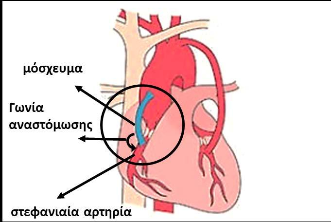 Σε παλαιότερες μελέτες αναφέρεται ότι κατά την αορτοστεφανιαία παράκαμψη (bypass) σπουδαίο ρόλο παίζει η γωνία αναστόμωσης μεταξύ του μοσχεύματος και της στεφανιαίας αρτηρίας, καθώς η αύξηση της