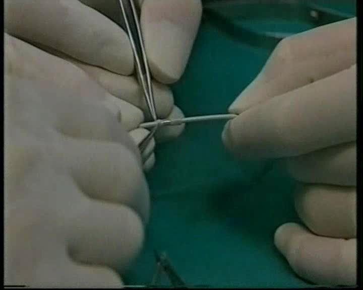 Αυτόλογο graft stent : πρόδρομο των σύγχρονων stents Η τοποθέτηση επενδεδυμένων stent με αυτόλογο μόσχευμα κερκιδικής αρτηρίας εφαρμόσθηκε για πρώτη φορά στην Α Καρδιολογική Κλινική του Πανεπιστημίου