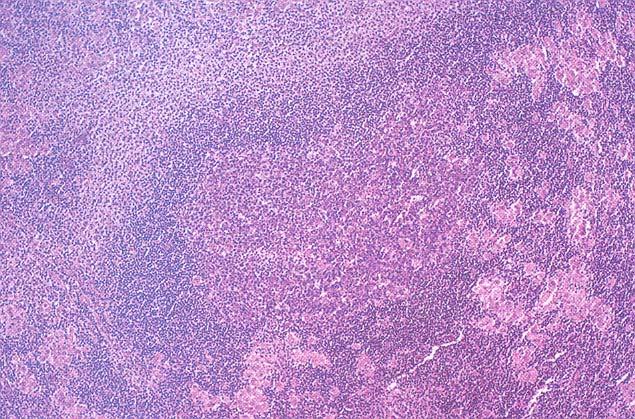 ΛΕΜΦΑΔΕΝΙΤΙΔΑ ΑΠΟ Toxoplasma gondii