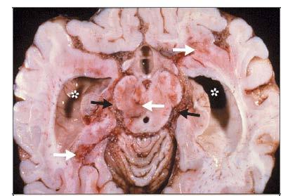 TB Μηνιγγίτιδα Εξίδρωμα (υδροκέφαλο,