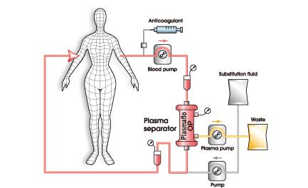 Αιμοκάθαρση και Πλασμαφαίρεση Κύκλωμα εξωσωματικής