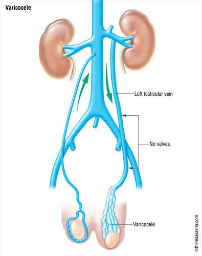 Διαφορά της εκβολής μεταξύ αριστερής και δεξιάς σπερματικής φλέβας ΑΡ υπό ορθή γωνία στην ΑΡ νεφρική