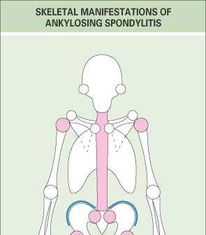 Σπονδυλαρθρίτιδες Αγκυλοποιητική σπονδυλίτιδα