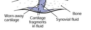 Οστεοαρθρίτιδα Φυσιολογική