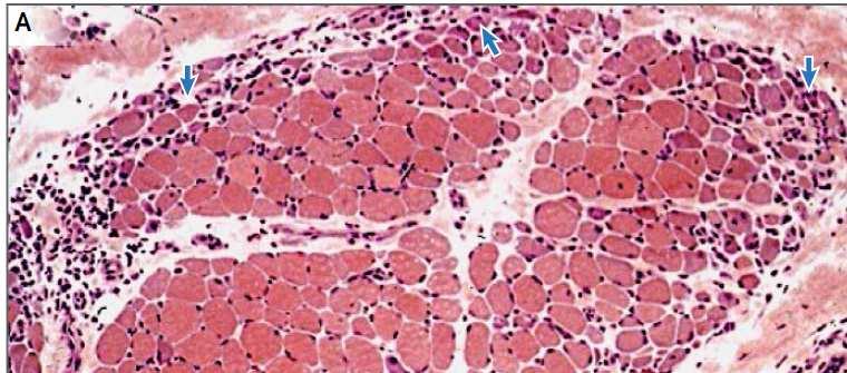 Μυοπάθεια από έγκλειστα (IBM-Inclusion Body Myositis) - Μυική αδυναµία ± Εξάνθηµα - CPK/ΑΝΑ+ -