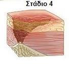 Τα έλκη που αναπτύσσονται στη μύτη, στα αυτιά, στο ινιακό οστό και στα σφυρά τα οποία δεν έχουν υποδόριο ιστό μπορεί να είναι ρηχά.