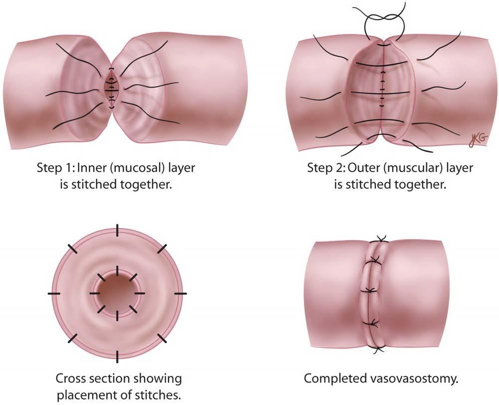 Συστάσεις Vaso-Vaso & other Anastomoses Μικροχειρουργική ανακατασκευή αν <15έτη Παράγοντες