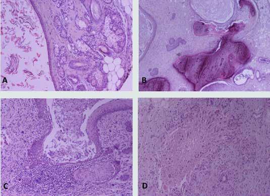 Ovarian teratoma in a bitch Figure 5. On cut surface the mass appears mostly gray in colour and multicystic. The cysts are less than 0.5cm in diameter, usually filled with viscous/gelatinous material.