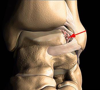 ποσοστό 17% Foot Ankle Int 2015;36:1045-9 Arthroscopic