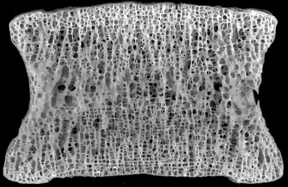 Σπογγώδης οστέινη ουσία Αποτελείται από δοκίδες, οι οποίες έχουν ακανόνιστο προσανατολισμό Ανάμεσα στις οστεοδοκίδες σχηματίζονται χώροι