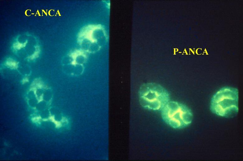 ANCA (antineutrophil cytoplasmic antibody) Περιγραφή με βάση το πρότυπο του