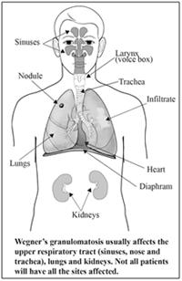 Κοκκιωμάτωση του Wegener Πυρετός, πολυαρθραλγίες / αρθρίτιδα Ανώτερο αναπνευστικό: πυώδης ρινόρροια, ρινικά έλκη, παραρρινοκολπίτιδα Κατώτερο αναπνευστικό: βήχας, αιμόπτυση,