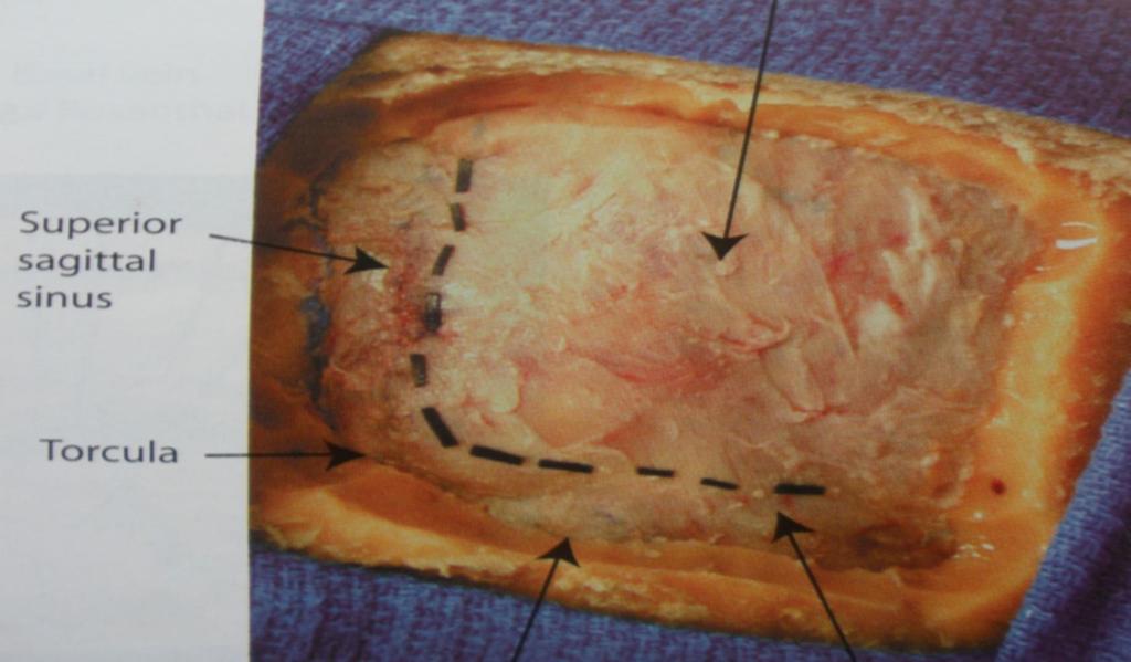 Confluens Craniotomy