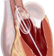 διενέργεια βαλβιδοπλαστικής με μπαλόνι 22mm