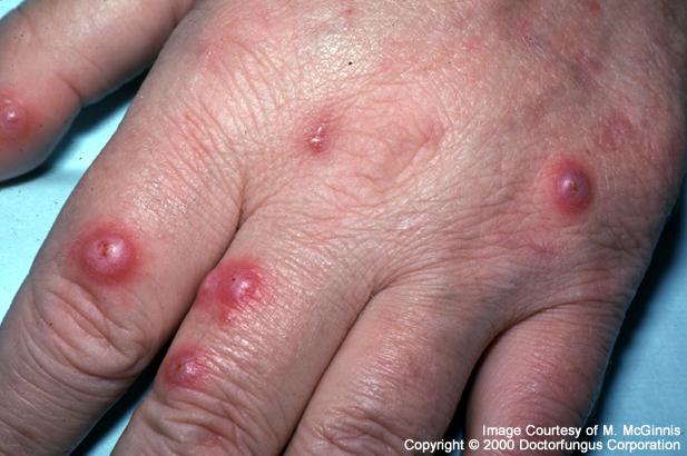 Cryptococcus neoformans