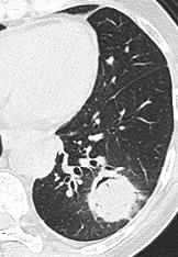 CT scan evolution during IPA