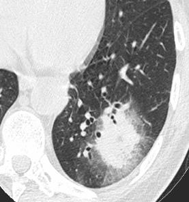 delayed Neutropenia PMN >> 500