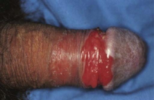 Ερυθροπλασία Queyrat Σχετιζόμενη με τον HPV 16 (αλλά και άλλους HPV) Louis Queyrat 1911 Άγνωστο αν υπάγεται στα ΣΜΝ