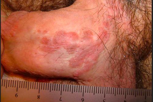 Συμμετοχή βουβωνικής - υπερηβικής χώρας HPV 16 αλλά και 2, 18,