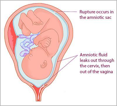 Ωσ Πρόωρθ Ριξθ Τμζνων (ΠΡΤ ι PROM Premature Rupture of Membranes) ορίηεται θ αυτόματθ ριξθ των εμβρυικϊν μεμβρανϊν πριν από τθν ζναρξθ του τοκετοφ.