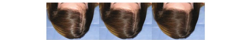 Hair Revitalizer Τριχόπτωση, αραίωση