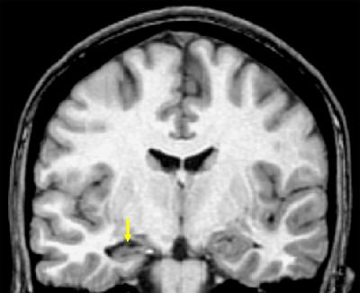 ΑΤΡΟΦΙΑ ΙΠΠΟΚΑΜΠΟΥ Η MRI μας