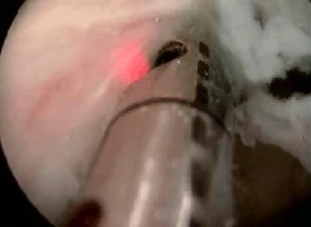 Ho:YAG Ablation of the prostate HoLAP Τεχνική: 1.