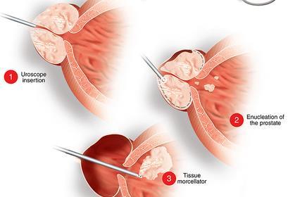Ho:YAG Resection of the prostate ΗοLRP Τεχνικη: η διαδικασία HoLRP χρησιμοποιεί την εξάτμιση μόνο για αφαιρέσει μικρά