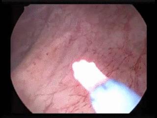 Thulium Laser (Tm:YAG) Mήκος κύματος ~2000 nm Continuous-wave Απορρόφηση στo νερό και στην