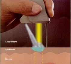 αποτελέσματα Lasers: Nd:YAG ή CO2 ή