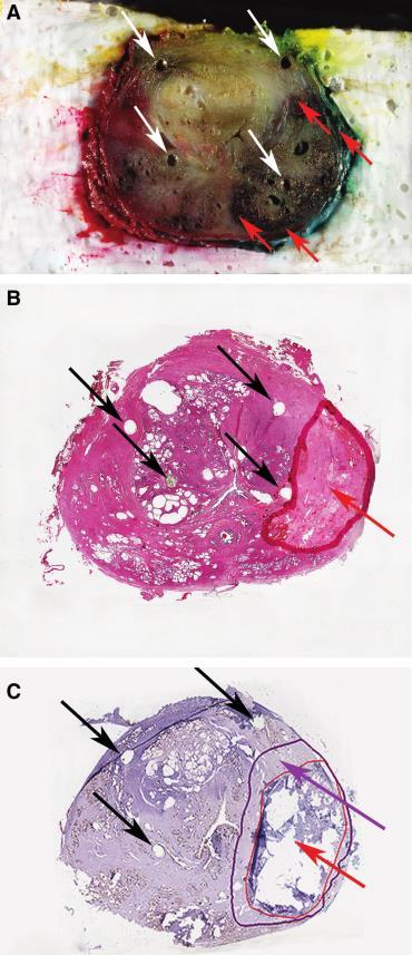 Focal LASER Ablation CaP MRI-guided χρήση diode laser