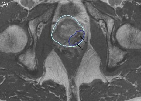 βιοψία 70% Στυτική δυσλειτουργία 6% Phase 1 trial