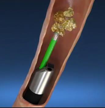 Holmium laser Μικρό βάθος διείσδυσης 0,5-1 mm κίνδυνος διάτρησης: