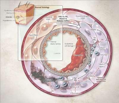 Nigwekar, nejm 2018, calciphylaxis, 2.
