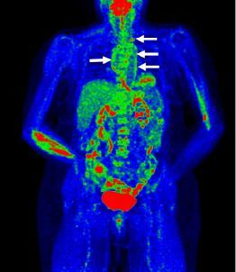 18 F-FDG PET/PET CT 18 F-FDG PET/PET CT (+) σε κλινική ύφεση Υποκλινική φλεγμονή αγγειακού τοιχώματος