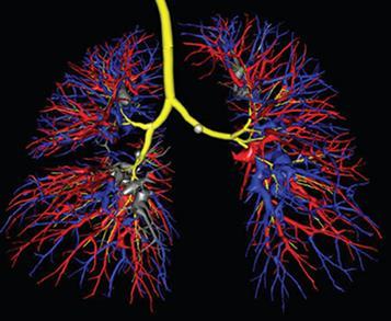 ARDS -φυσιολογία Πνευμονική κυκλοφορία PVR: απόφραξη αγγείων