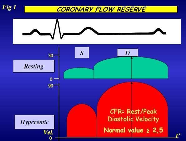 Coronary flow velocity profile obtained with tranthoracic