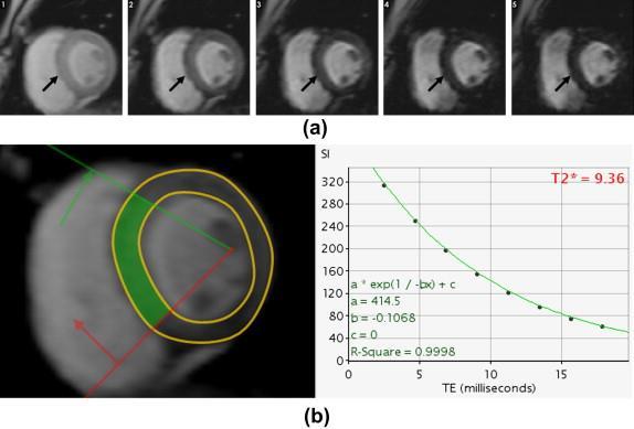 Iron-overload cardiomyopathy. (a) This short axis image shows a bright-blood T2* sequence from a transfusiondependent patient with thalassaemia.