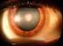 Ниво редукованог глутатиона и активност глутатион-зависних ензима у кортиконуклеарним блоковима сочива особа са сенилном катарактом