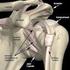 Acromioclavicular region as a proximal anchorage point of the external fixation pins for comminuted fractures of the proximal humerus