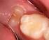 Ανατολή και απόπτωση των πρώτων νεογιλών δοντιών σε σχέση με την ανατολή των μόνιμων και παράγοντες που τις επηρεάζουν